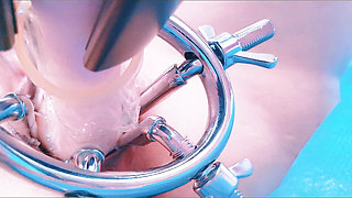 Speculum